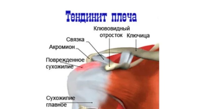 Болят плечевые суставы причины