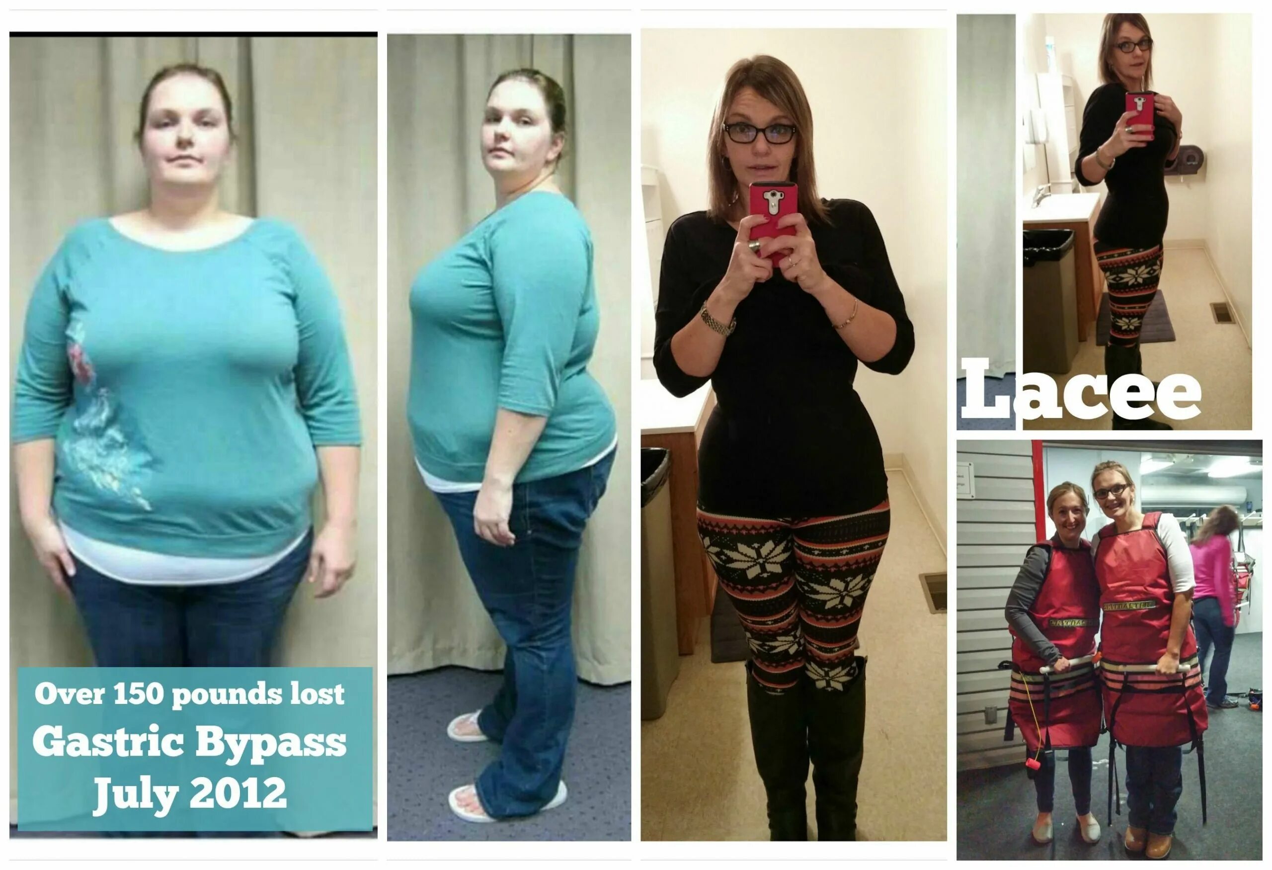 резекция желудка для похудения до и после. похудение операция отзывы. похудение операция отзывы. похудение операция отзывы. операция по уменьшению желудка.