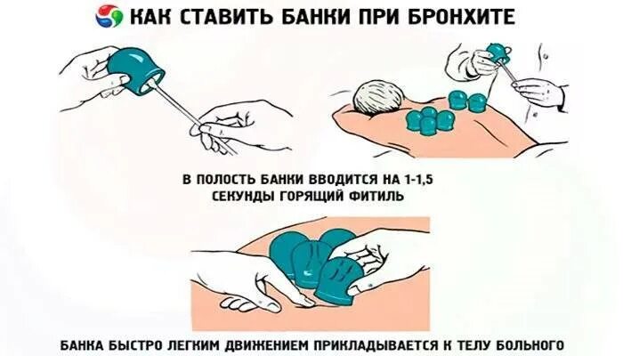 При каком кашле ставят банки. Как правильно поставить банки на спину. постановка банок на спину при кашле. схема постановки банок стеклянных на спину. схема постановки медицинских банок.