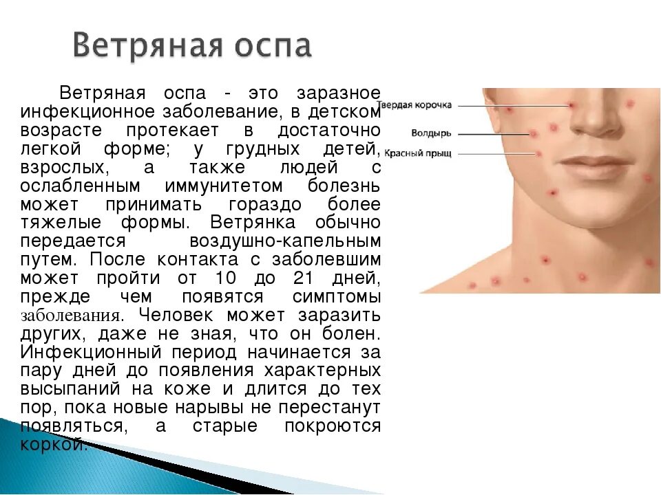 Ветряная оспа.Государственное учреждение образования "Ясли-сад № 41 г.Лиды"