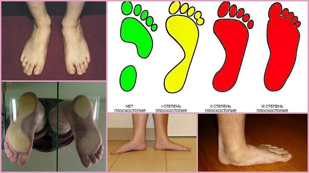 Плоскостопие на одной ноге берут ли. Симптомы продольного и поперечного плоскостопия. Плантография поперечного плоскостопия. Продольное плоскостопие 2. Поперечно продольное плоскостопие 3 степени.