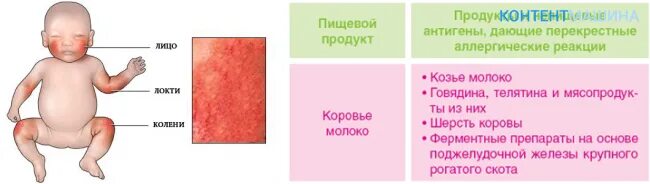 Как выглядит как проходит. Пищевая аллергия у ребенка грудничка. сыпь при лактазной недостаточности у новорожденного. как выглядит пищевая аллергия у ребенка в 1 год. атопический дерматит у грудничка.