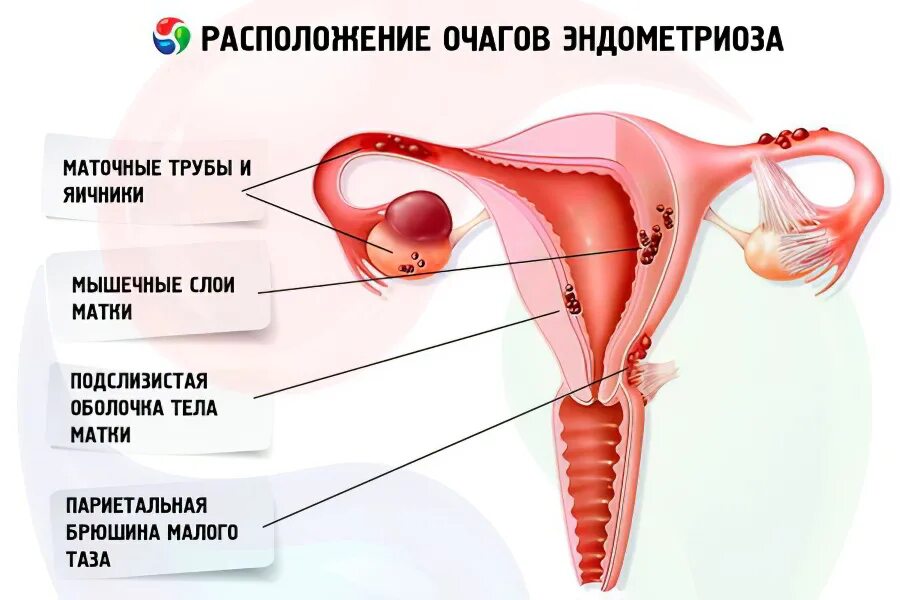 Расположение матки и маточных труб. Расположение матки и эндометриоз. Маточные трубы расположение. Эндометриоз трубы и яичника.