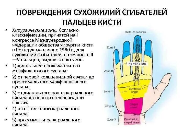 Зоны повреждения сухожилий сгибателей пальцев. Травма сухожилий кисти классификация. Повреждения сухожилий разгибателей кисти диагностика. Сухожилия разгибателей пальцев кисти зоны.