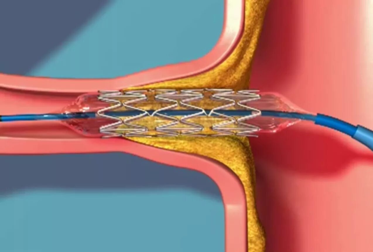 Болит стент. Катетер стент мочеточниковый. Стентирование почечной артерии. Стентирование сосудов мочеточника. Стентирование сосудов почек.