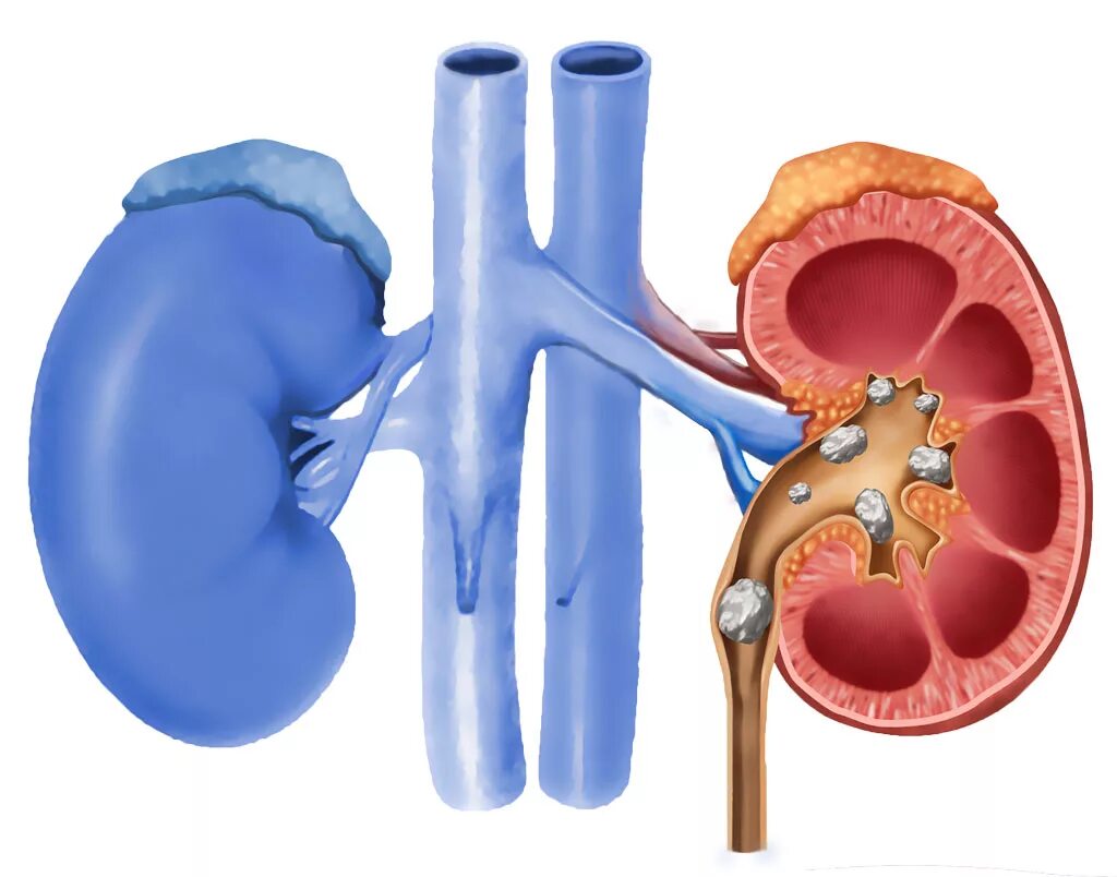 Камни в почках заболевание. Мочекаменная болезнь камни в почках. Локализация камней в почках. Камни в почках (конкременты).