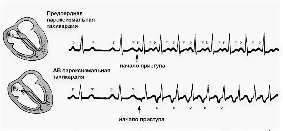 Пароксизмальная тахикардия код