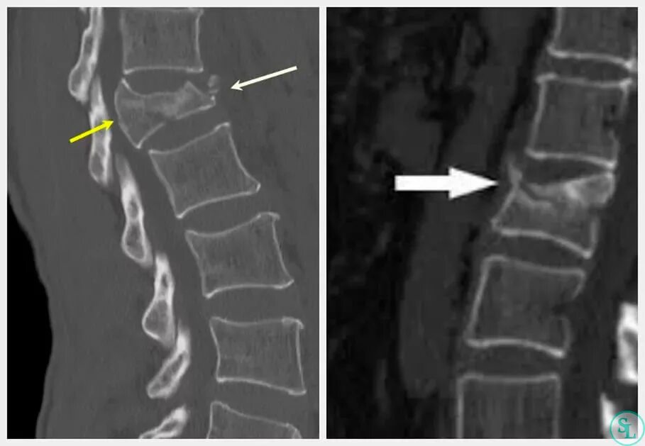 Может ли зажить трещина. Компрессионный перелом c5 c6. Компрессионный перелом рентген. Остеопороз компрессионный перелом позвоночника. Компрессионный перелом th4 что это такое.