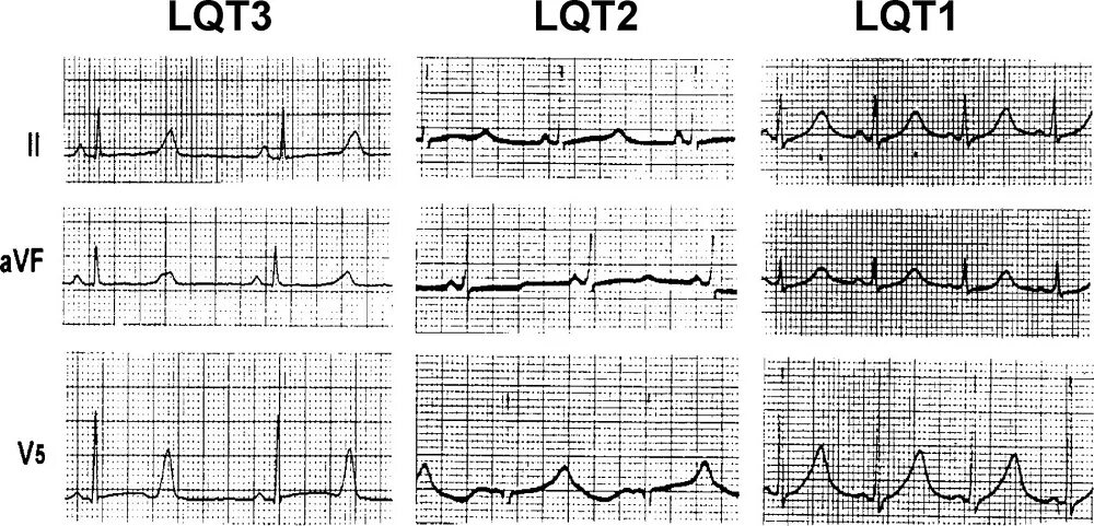 Синдром Бругада синдром удлиненного интервала qt. Синдром Романо Уорда на ЭКГ. Синдром удлиненного qt на ЭКГ. Синдром удлиненного интервала qt Тип 2. Удлиненное qt у ребенка