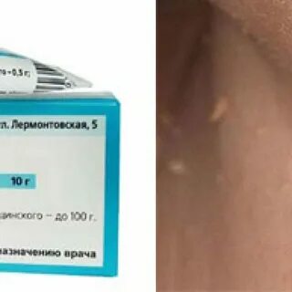 Причина папиллом на теле у мужчин