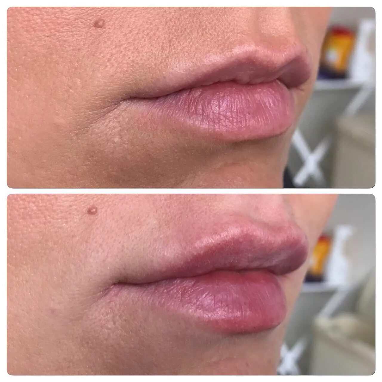 Биоревитализация губ до и после. Коррекция губ.