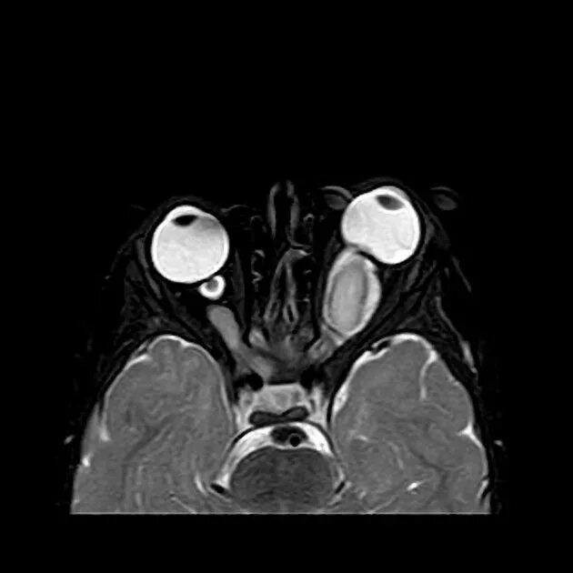 Мрт глазного нерва. Нейрофиброматоз глиома зрительного. Нейрофиброматоз мрт головной мозг. Менингиома зрительного нерва мрт. Глиома зрительного нерва мрт.
