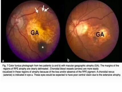 Age related macular degeneration