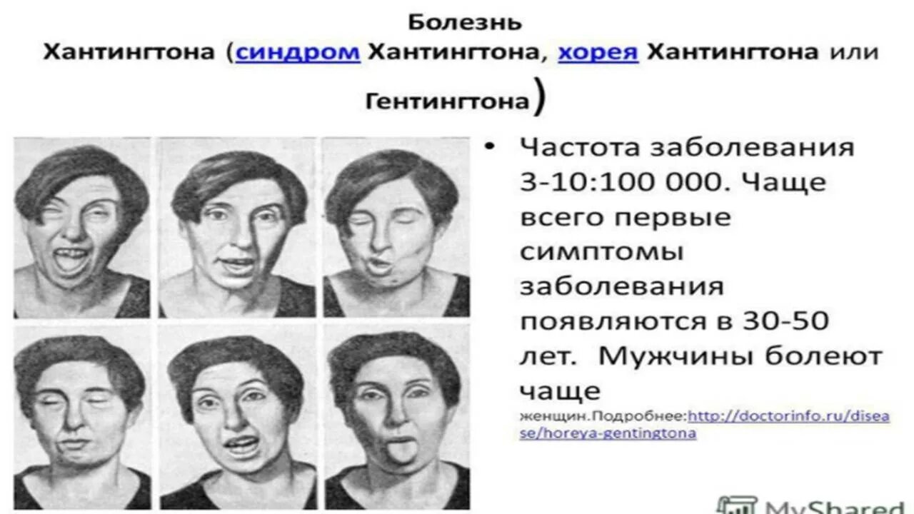 Хорея болезнь симптомы у взрослых. Хорея гентингтона клинические формы. симптомы хорея гентингтона болезнь хантингтона. хорея гентингтона клинические проявления. дебют хорея гентингтона.