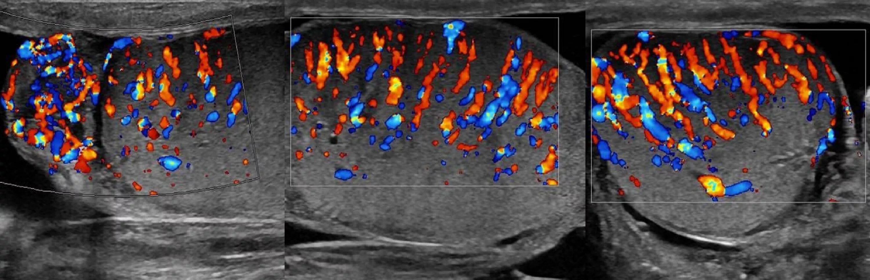 Нормальная яичка мужчин. Воспаление семенного канатика на УЗИ.