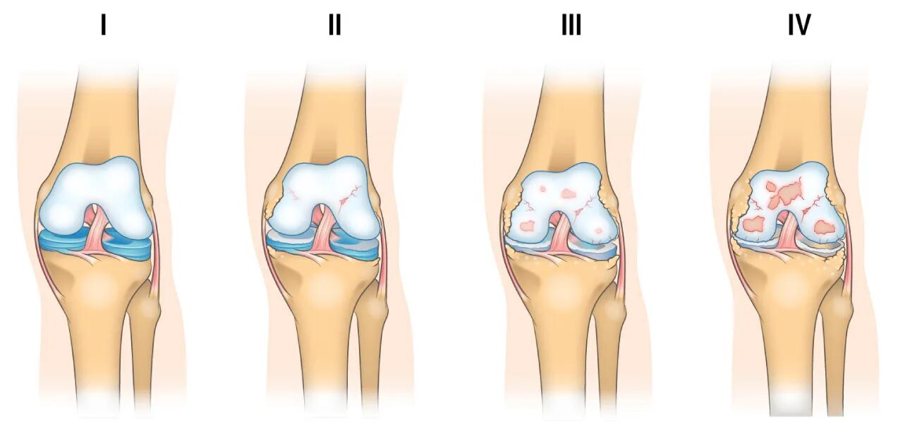 Коленный сустав по стадиям. Kellgren Lawrence артроз коленного. Остеоартрит 1-2 степени коленного сустава. Стадии по Келлгрен Лоуренс коленного. Остеоартроз артрит 1 степени.