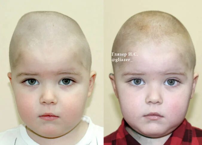 Краниосиностоз мутация гена. Затылочная плагиоцефалия. Асимметрия головы. Краниосиностоз плагиоцефалия. Плагиоцефалия у грудничка.
