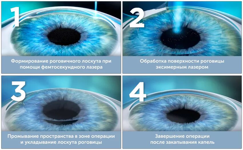 Коррекция зрения смайл цена со скидкой спектр. Лазерная коррекция зрения методом ласик. Лазерная коррекция Femto LASIK. Операция Фемто супер ласик.