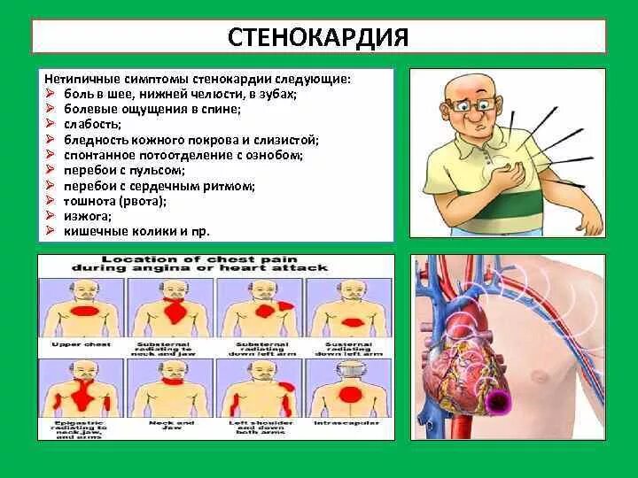 Первые симптомы стенокардии. Признаки стенокардии. Стенокардия симптомы. Стенокардия грудная жаба симптомы. Стенокардия это проявление.