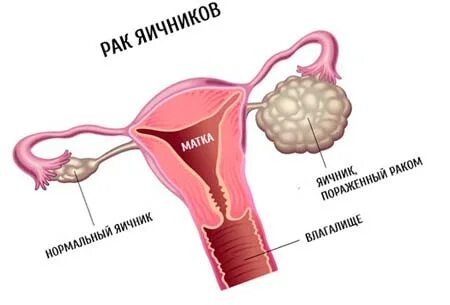 Опухоли яичников беременность