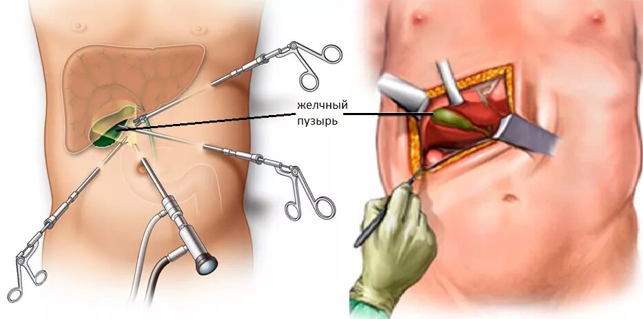 Лапаротомия холецистэктомия. Холецистэктомия желчного пузыря лапароскопическая. Холецистит и лапароскопическая холецистэктомия. Операция минилапаротомия холецистэктомия. Абдоминальная операция что это