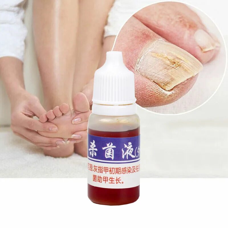 Китайское средство от грибка ногтей Nail fungus. Китайский крем от грибка ногтей Nail fungus. Китайский препарат от грибка ногтей. Китайское масло от грибка ногтей. Лечение грибка маслом