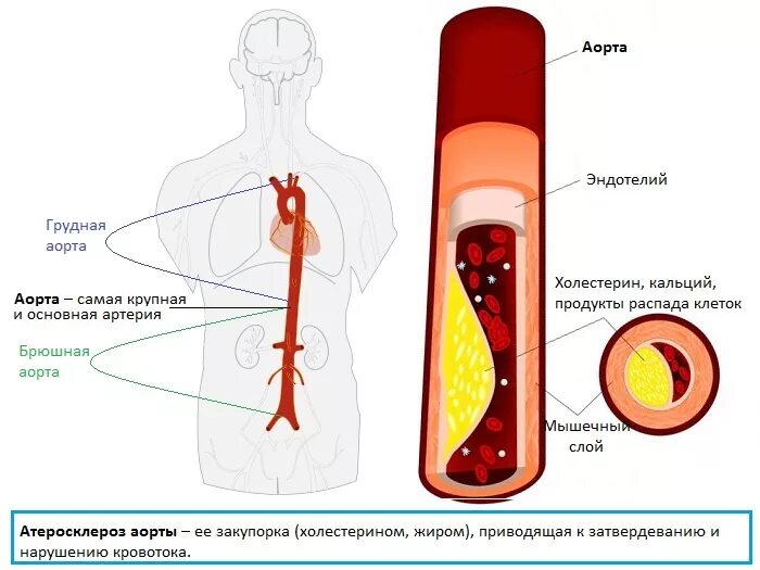 Клинические проявления атеросклероза аорты. Атеросклеротические изменения стенок аорты. Атеросклероз грудного отдела аорты. Атеросклероз аорты и ее ветвей.