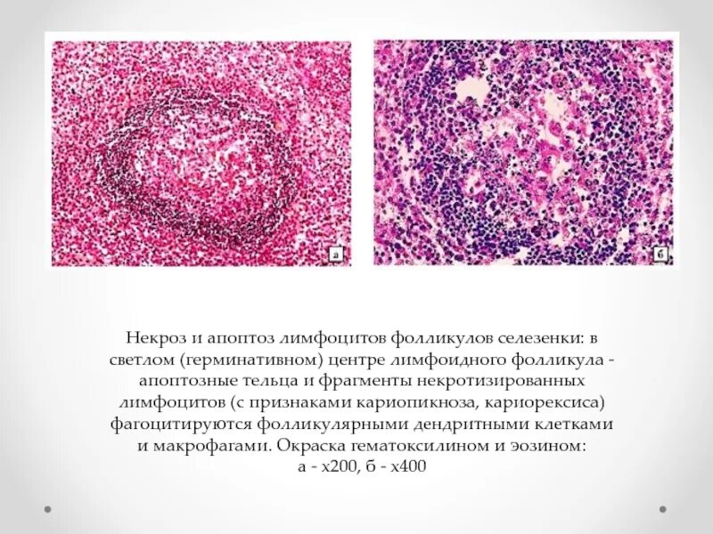 Фолликулярная гиперплазия желудка. Фолликулярная гиперплазия желудка. Фовеолярно гиперпластический полип. Фолликулярная гиперплазия желудка. Полип толстой кишки гистология.