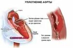 Аорта и клапаны уплотнены
