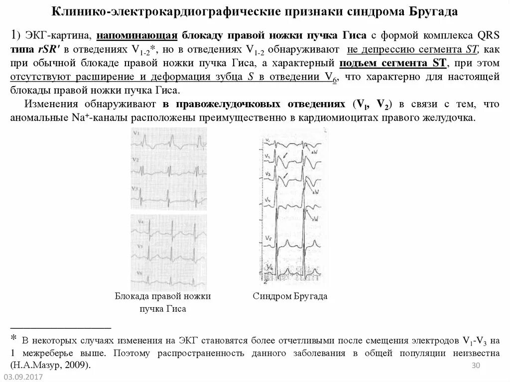 Бругада экг признаки. Синдром бругада тип 2 экг. Бругада экг признаки. Синдром бругада экг критерии. Синдром бругада тип 2 экг.