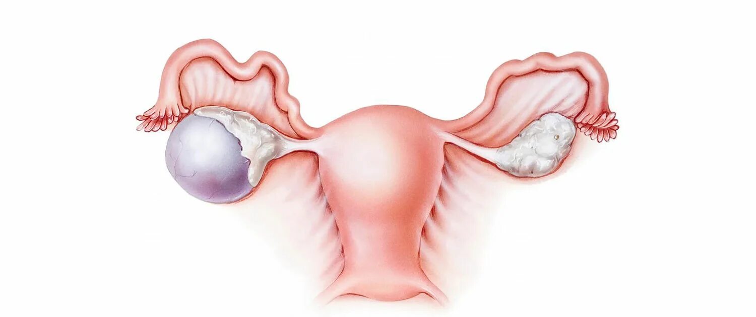 Дермоидные кисты яичников. Миома матки ,кисты яичников. Апоплексия кисты яичника. Ретенционная киста яичника. Взаимосвязь яичника