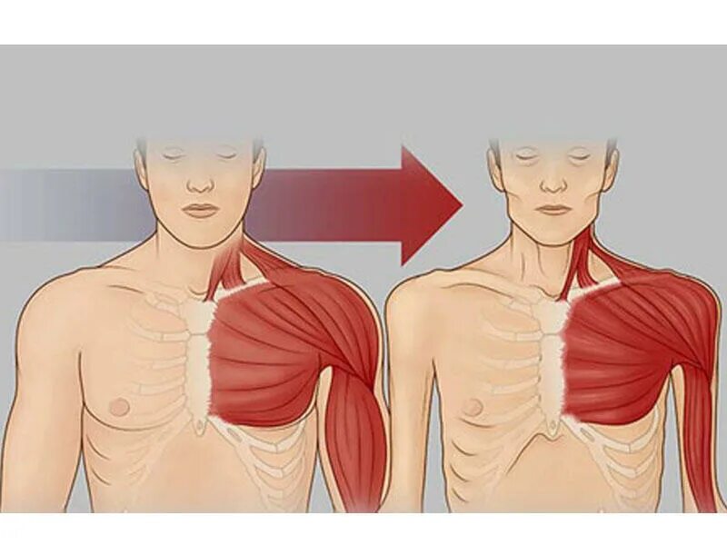 Гипоплазия большой грудной мышцы. Растяжка мышц плечевого пояса. Синдром поланда грудная мышца. Миозит большой грудной мышцы. Туннельный синдром малой грудной мышцы.