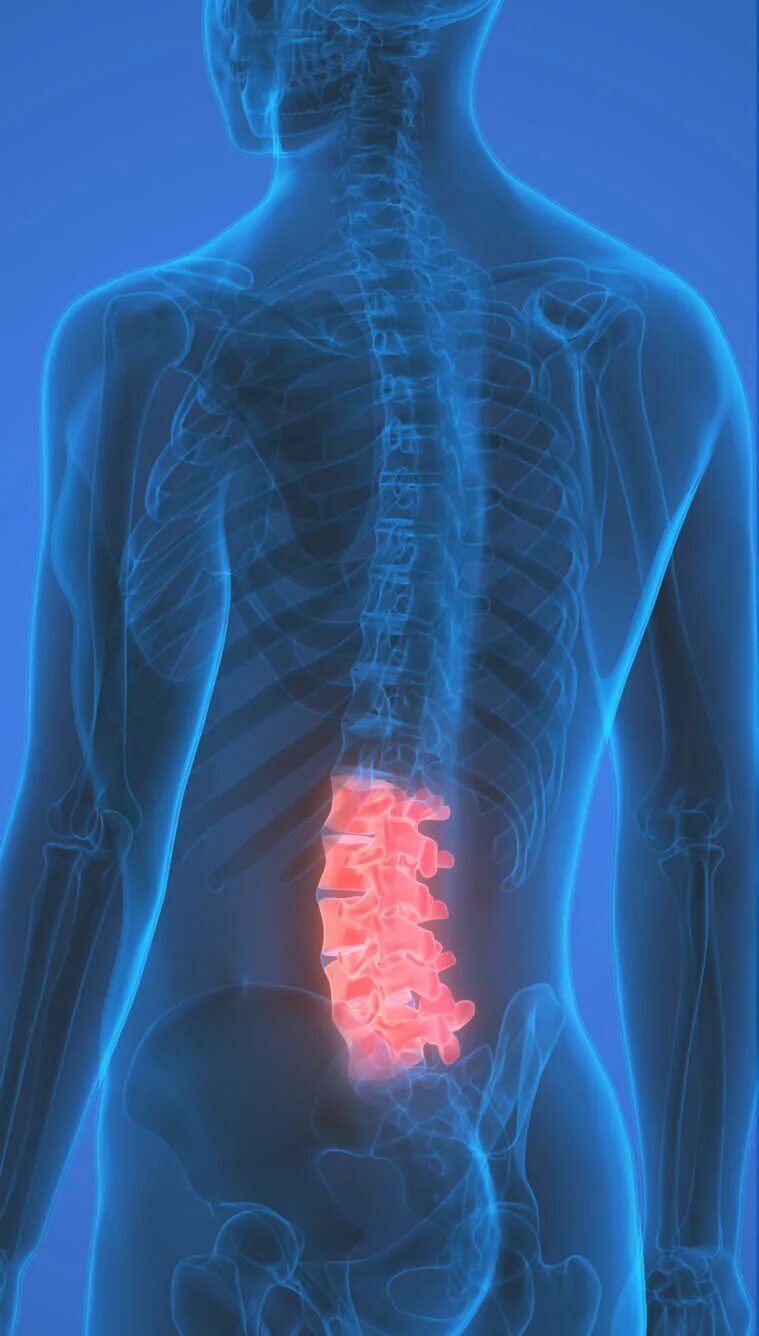 Опухшая поясница. Позвоночник. Поясничный отдел. Поясничный позвоночник.