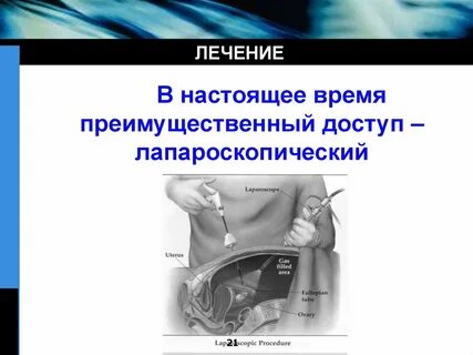 Внематочная беременность операция сроки
