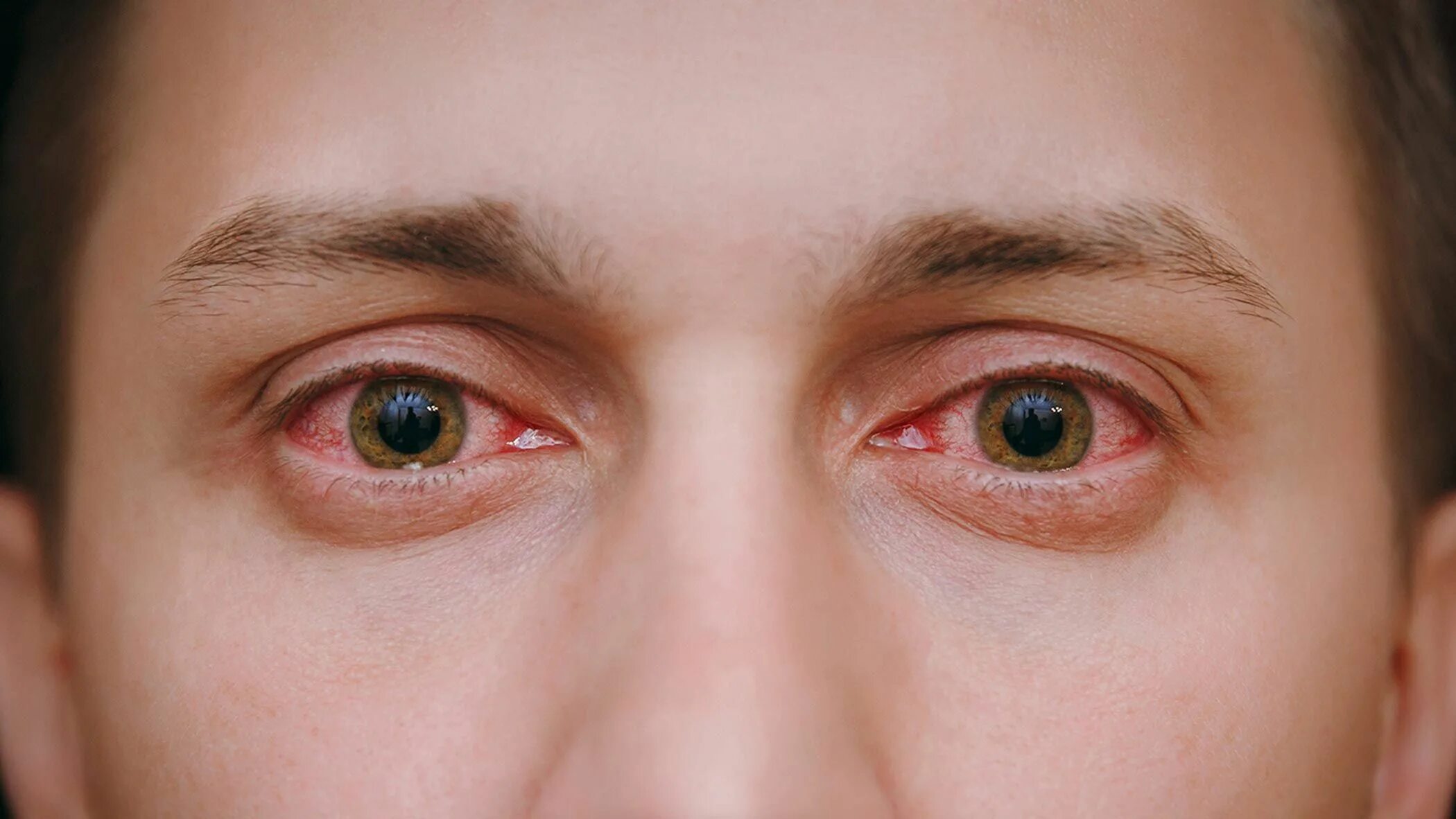 Retouch4me Eye Vessels 1.010. Лимбальный кератоконъюнктивит. Красные глаза конъюнктивит. Расширение зрачков симптомы