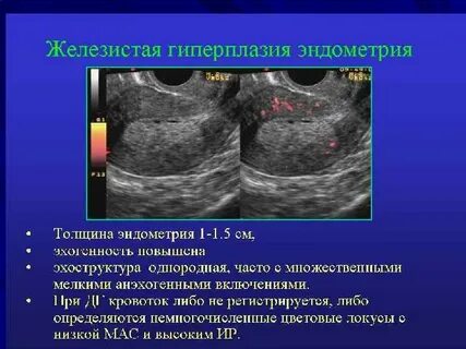 Психосоматика гиперплазии эндометрия