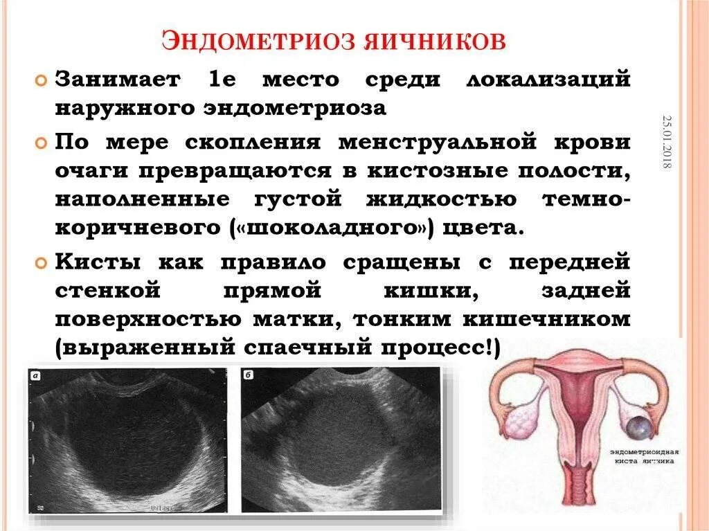 Эндометриоидной кисты. Эндометриоидные опухоли яичников.