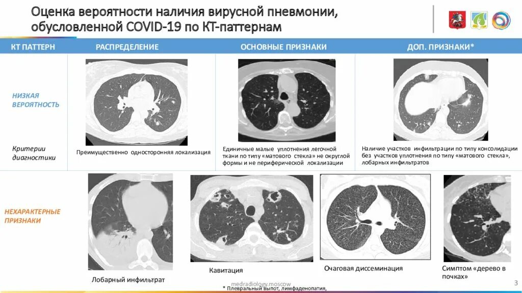 Чем отличается пневмония от ковида 19. Пневмония при Ковиде на кт. Вирусная пневмония ковид кт. Кт признаки разрешения пневмонии вирусно. Вирусно-бактериальная пневмония кт.