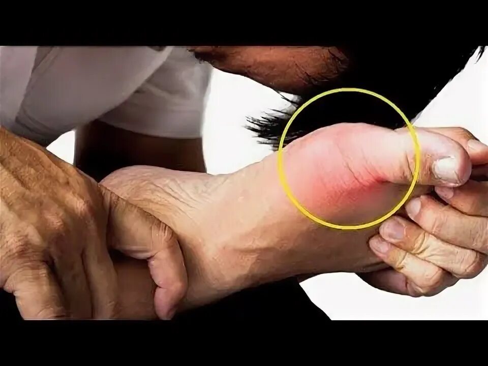 Reasons for high Uric acid - YouTube
