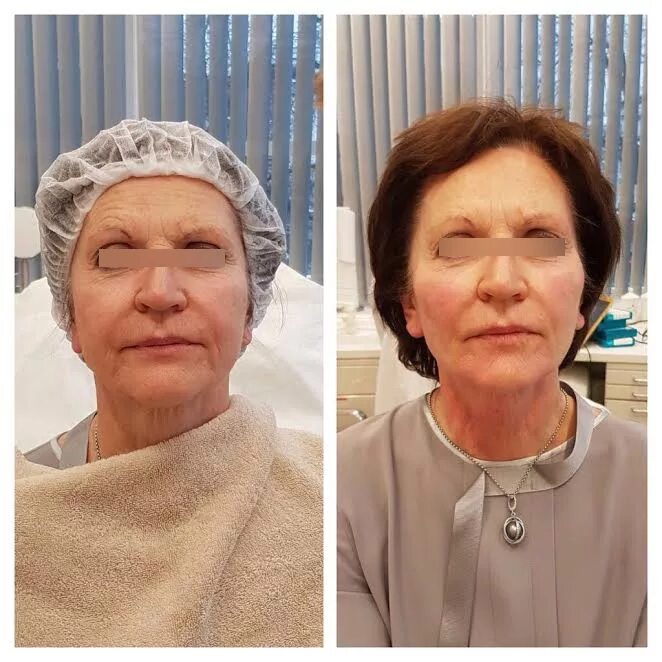 векторный лифтинг radiess. веерный лифтинг. Radiesse векторный лифтинг до и после. векторный лифтинг радиесс техника введения. векторный лифтинг до и после.