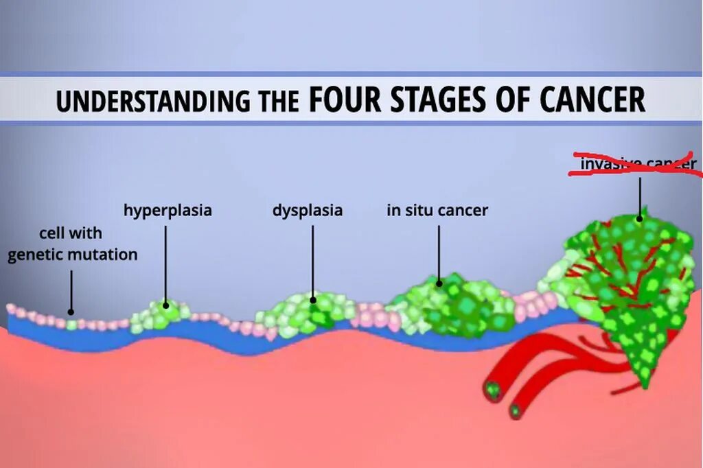 Stages of Cancer Development. Stages of cancer