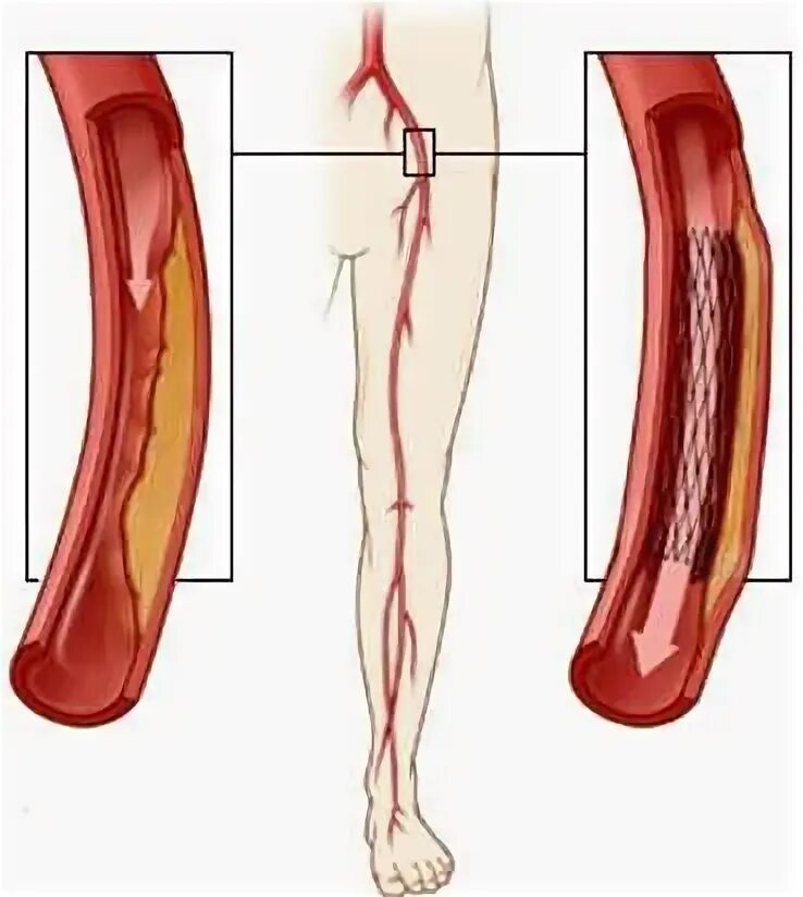 Эндоваскулярное стентирование. Атеросклероз сосудов стентирование. Баллонная ангиопластика артерий нижних конечностей. Баллонная ангиопластика и стентирование.