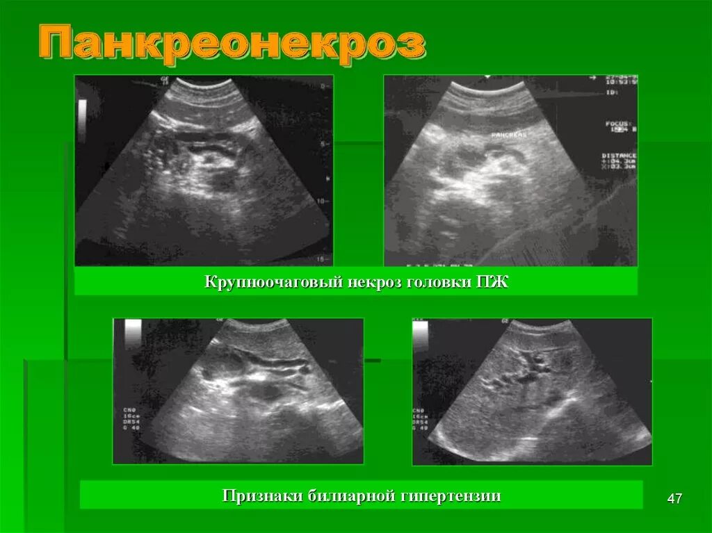 Билиарная гипертензия это. Некроз поджелудочной железы на УЗИ. Панкреонекроз УЗИ картина. Крупноочаговый панкреонекроз.