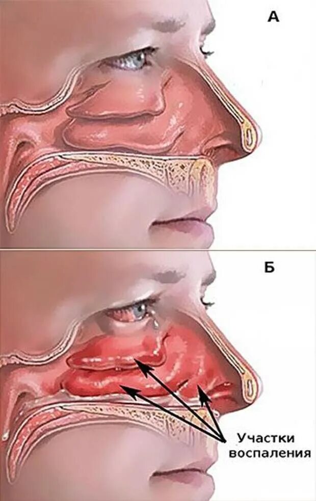 Зуд в носу при простуде. Острый вазомоторный ринит. Слизистая носа вазомоторный ринит. Острый катаральный ринит. Вазомоторный ринит носовые раковины.