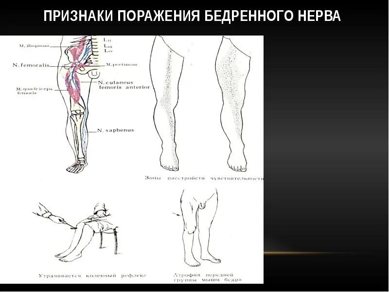 Мералгия бернгардта-рота. Защемило бедренный нерв. Невропатия бедренного нерва анатомия. Латеральный наружный кожный нерв бедра. Невропатия бедренного нерва анатомия.