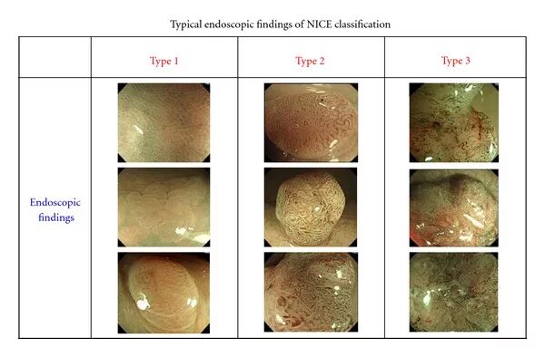 Nice классификация полипов. Классификация полипов толстой кишки по nice. Классификация полипов толстой кишки по КУДО. Классификация полипов кишечника эндоскопическая. Классификации эндоскопия