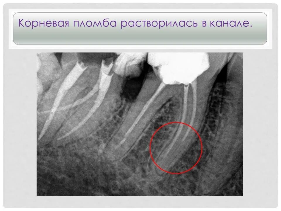 Почему больно зуб после лечения