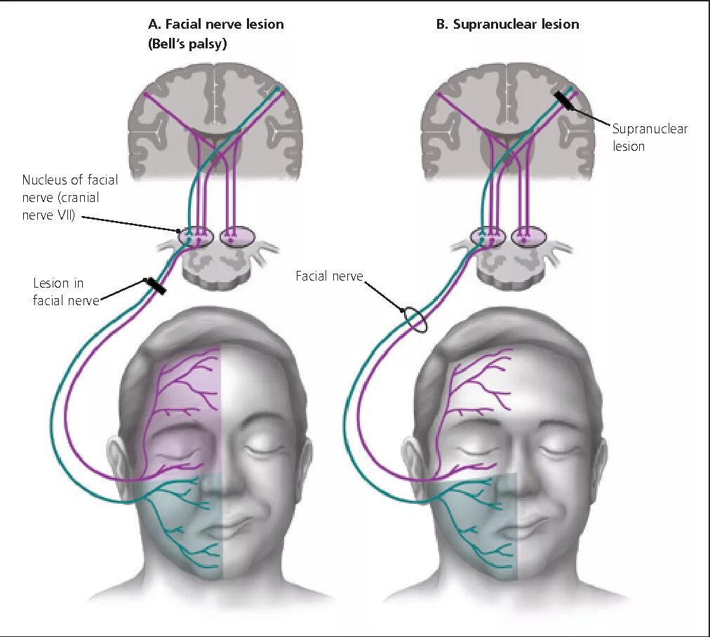 Парез латынь. Центральный и периферический парез лицевого нерва. Центральный парез лицевого нерва поражение. Периферический парез лицевого нерва патогенез. Неврит лицевого нерва Центральный и периферический.