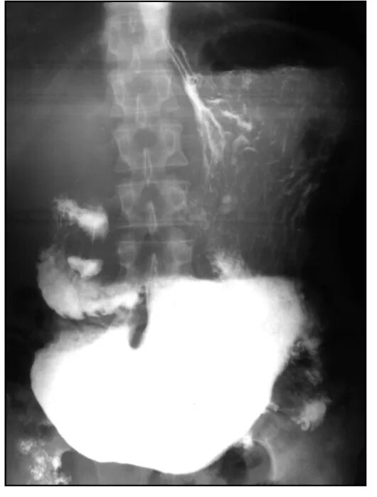 Трещина в кишечнике. Стеноз 12 перстной кишки рентген. Стеноз привратника рентген. Декомпенсированный стеноз привратника рентген. Гастродуоденальный стеноз рентген.
