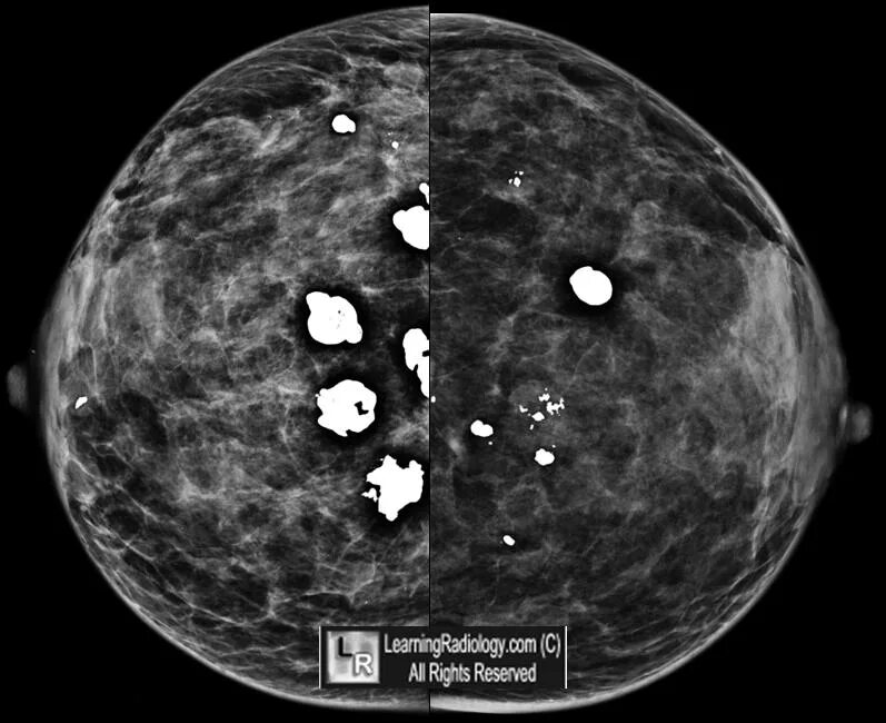 Округлые кальцинаты. Маммография микрокальцинаты. Внутрипротоковые кальцинаты. Злокачественные кальцинаты.